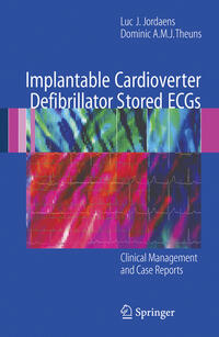 Implantable Cardioverter Defibrillator Stored ECGs