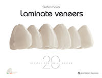 Laminate Veneers