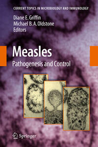 Measles