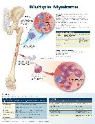 Multiple Myeloma Anatomical Chart